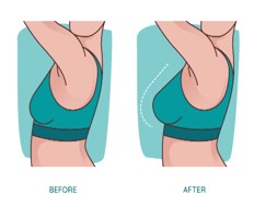 Breast Enlargement Surgery