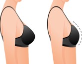 Breast Reduction Surgery