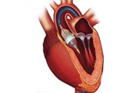 Transcatheter aortic valve replacement